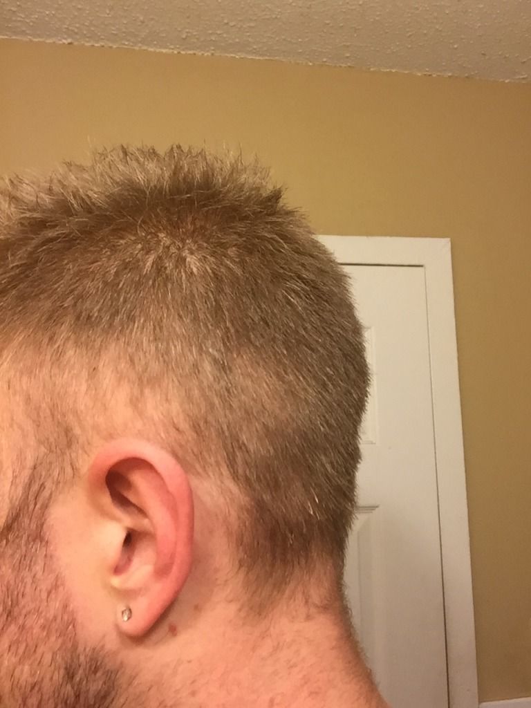 Northwest Lace, LLC Hair Loss Forum Retrograde