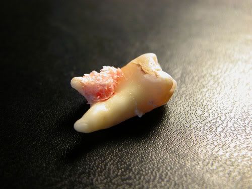 My Wisdom Teeth