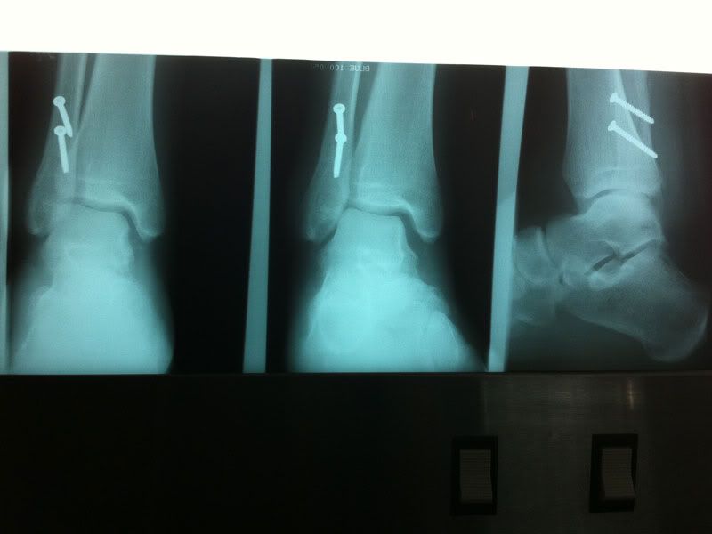 ankle-with-screws_sm.jpg