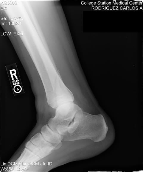 ankle0003_c.jpg