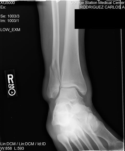 ankle0004_c.jpg