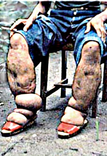 elephantiasis Pictures, Images and Photos