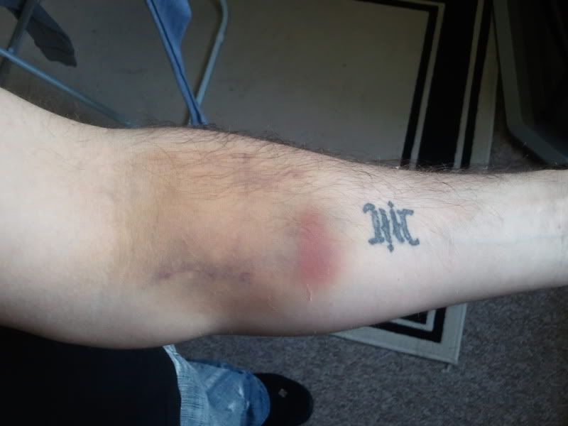 weird bruise
